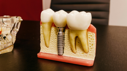 implant
